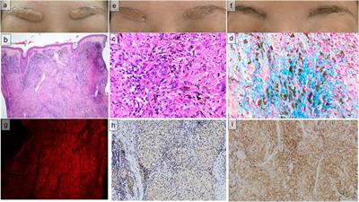 A case of sarcoidal foreign body reaction to permanent makeup: the involvement of M2 macrophages